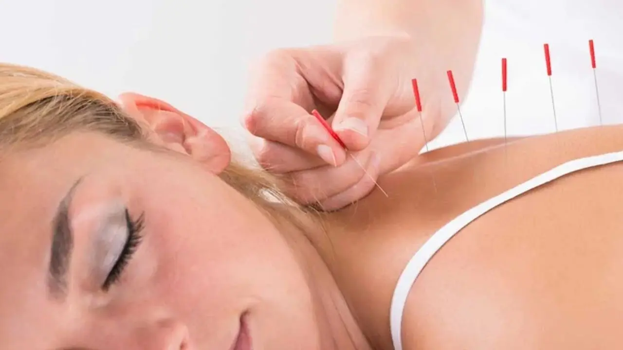Akupunktur Tedavisi