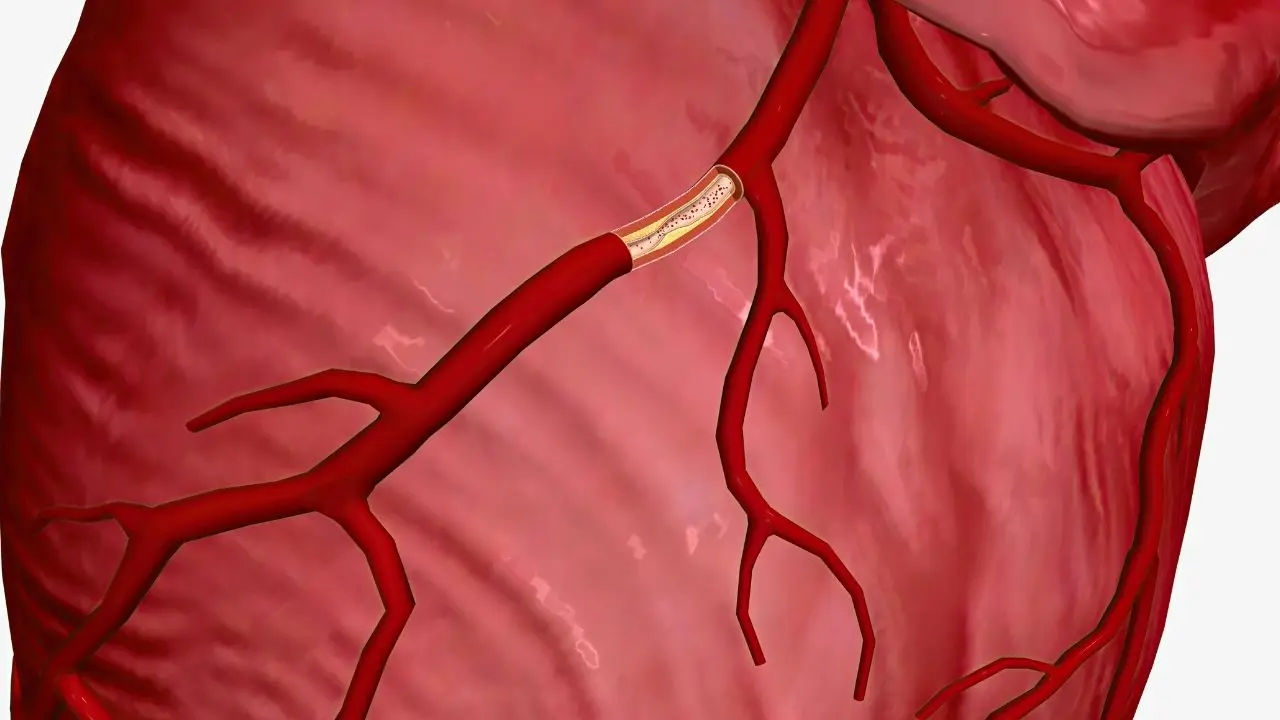 Endovasküler Embolizasyon